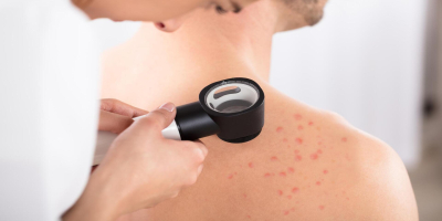 NI EL BRONCEADO PROTEGE NI EL MELANOMA APARECE SIEMPRE EN UN LUNAR: LOS MITOS DEL VERANO SOBRE EL CÁNCER DE PIEL