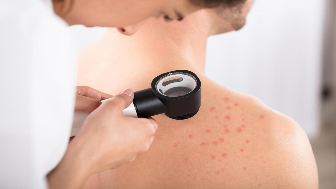 NI EL BRONCEADO PROTEGE NI EL MELANOMA APARECE SIEMPRE EN UN LUNAR: LOS MITOS DEL VERANO SOBRE EL CÁNCER DE PIEL